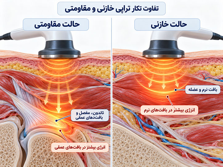 Capacitive vs resistive tecar therapy
