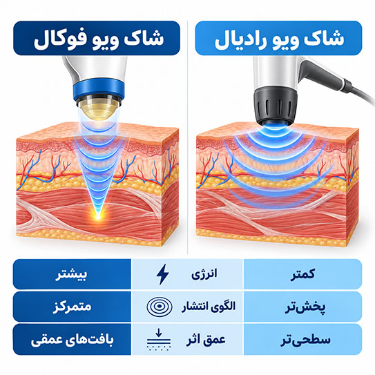 تفاوت شاک ویو فوکال و رادیال و نحوه انتشار امواج در بافت