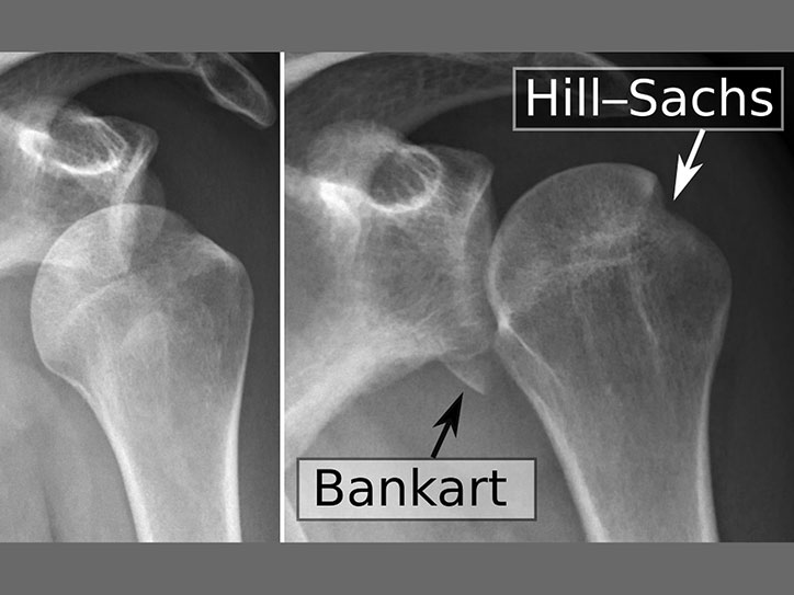 Shoulder dislocation xray